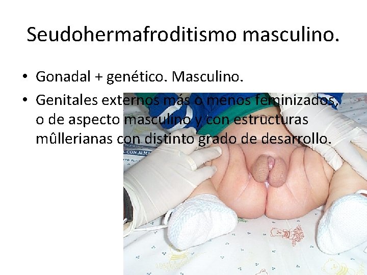 Seudohermafroditismo masculino. • Gonadal + genético. Masculino. • Genitales externos más o menos feminizados,