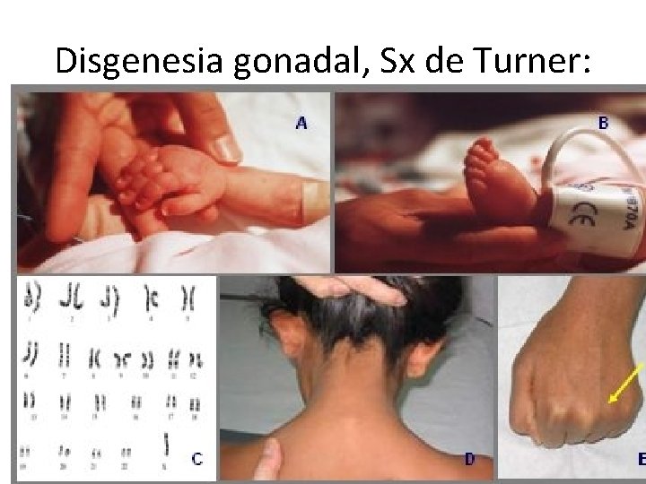 Disgenesia gonadal, Sx de Turner: 