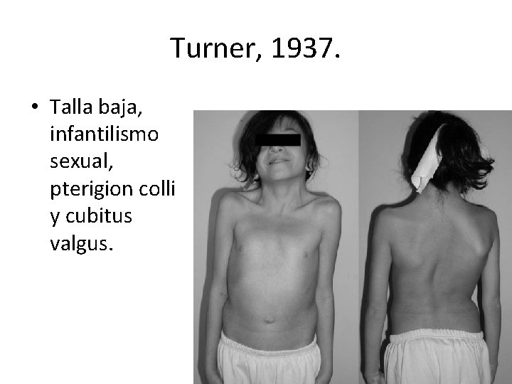 Turner, 1937. • Talla baja, infantilismo sexual, pterigion colli y cubitus valgus. 