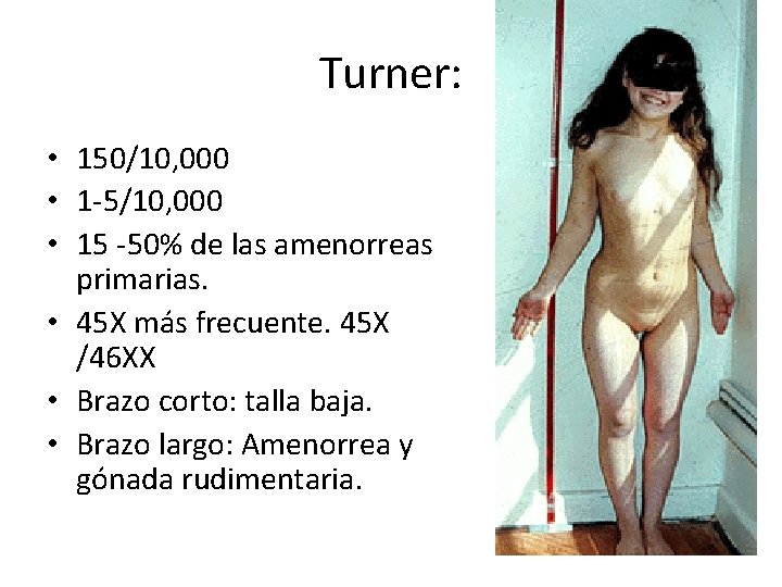 Turner: • 150/10, 000 • 1 -5/10, 000 • 15 -50% de las amenorreas