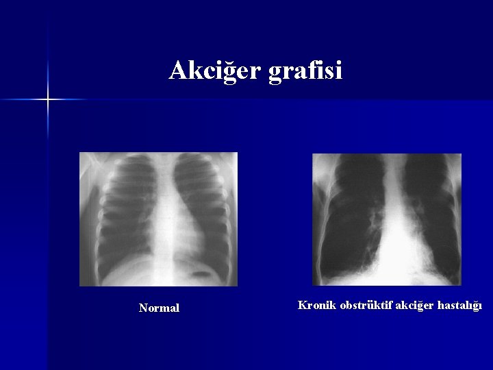 Akciğer grafisi Normal Kronik obstrüktif akciğer hastalığı 