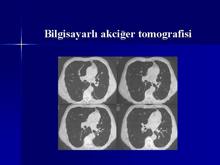 Bilgisayarlı akciğer tomografisi 