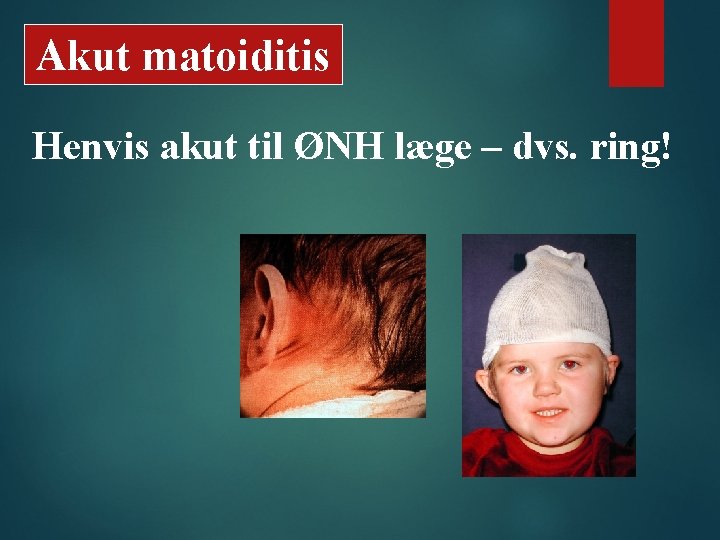 Akut matoiditis Henvis akut til ØNH læge – dvs. ring! 