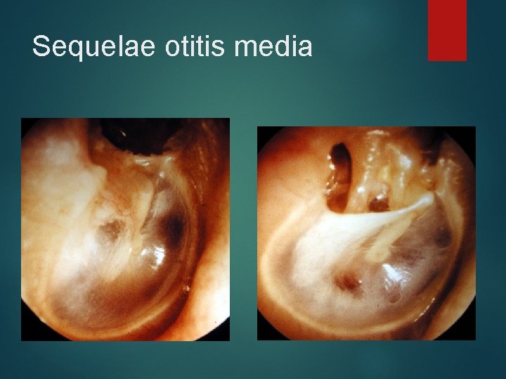 Sequelae otitis media 