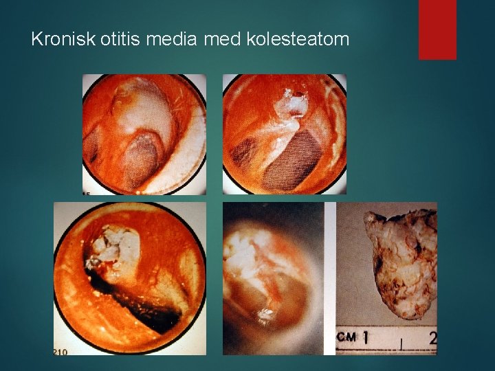 Kronisk otitis media med kolesteatom 