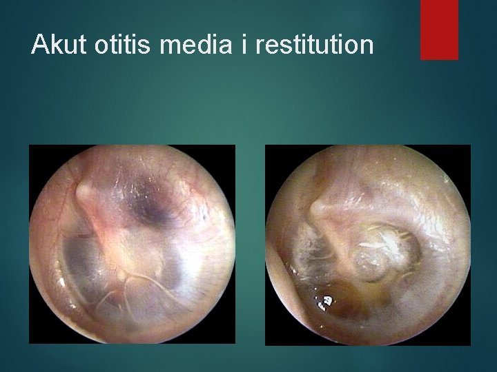 Akut otitis media i restitution 