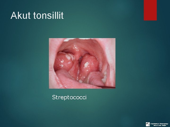 Akut tonsillit Streptococci Department of Otolaryngology Head & Neck Surgery 