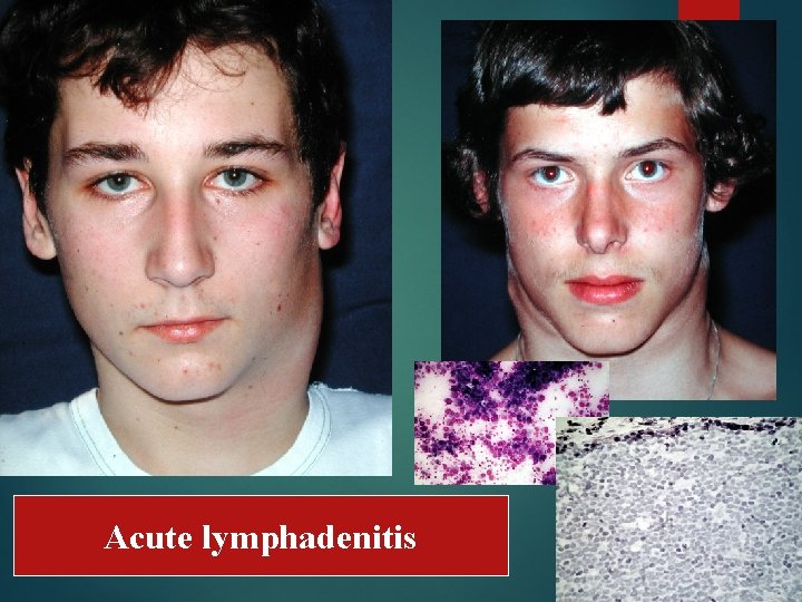Acute lymphadenitis 