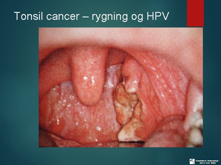 Tonsil cancer – rygning og HPV Department of Otolaryngology Head & Neck Surgery 