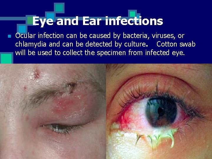 Eye and Ear infections n Ocular infection can be caused by bacteria, viruses, or