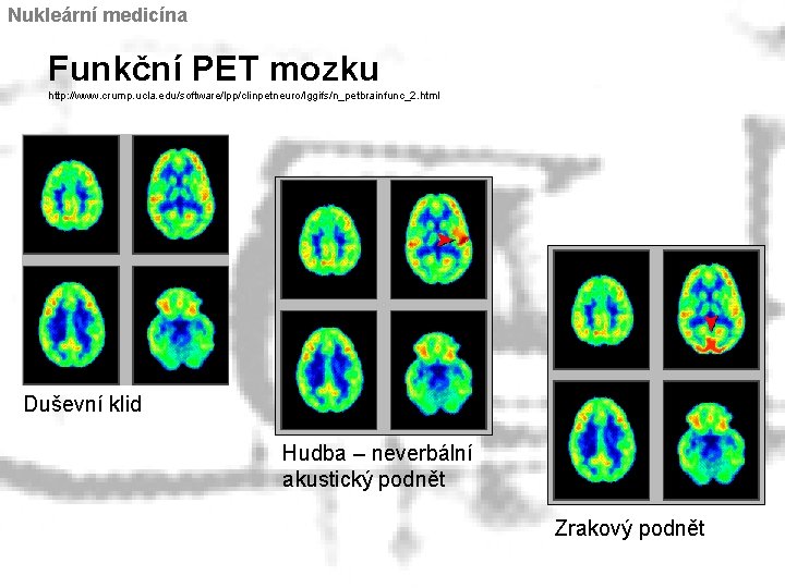 Nukleární medicína Funkční PET mozku http: //www. crump. ucla. edu/software/lpp/clinpetneuro/lggifs/n_petbrainfunc_2. html Duševní klid Hudba