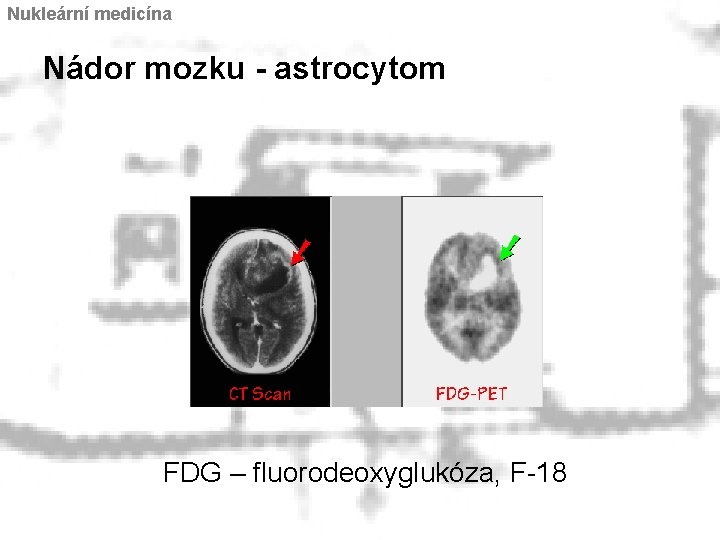 Nukleární medicína Nádor mozku - astrocytom FDG – fluorodeoxyglukóza, F-18 