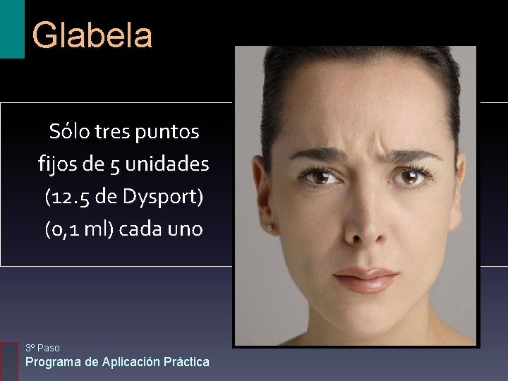 Glabela Sólo tres puntos fijos de 5 unidades (12. 5 de Dysport) (0, 1