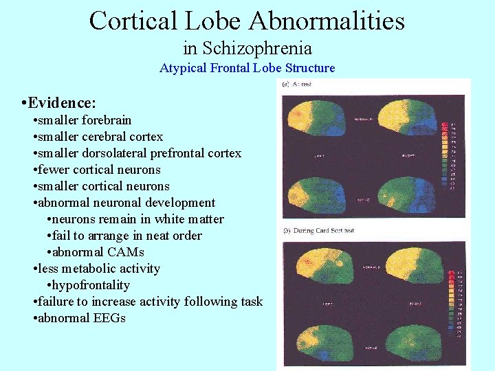 Cortical Lobe Abnormalities in Schizophrenia Atypical Frontal Lobe Structure • Evidence: • smaller forebrain