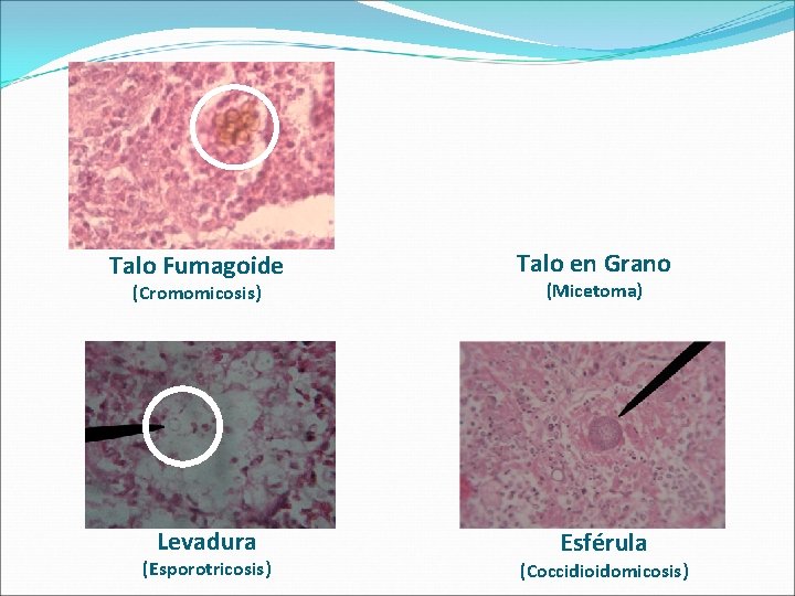 Talo Fumagoide Talo en Grano (Cromomicosis) (Micetoma) Levadura Esférula (Esporotricosis) (Coccidioidomicosis) 