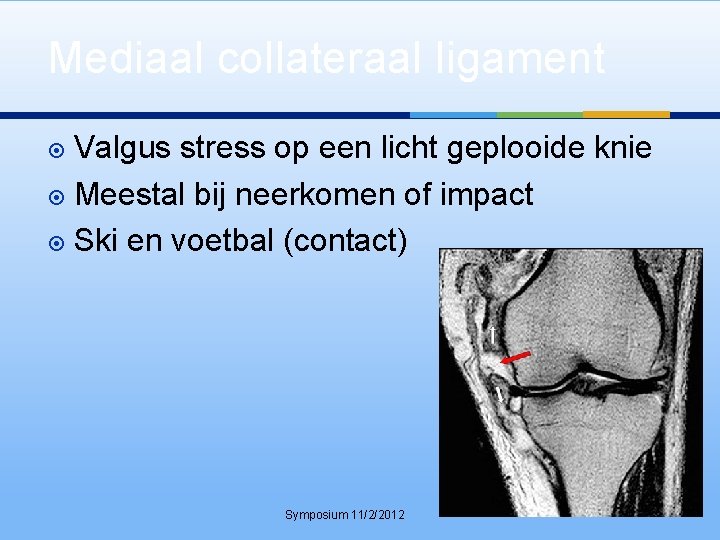 Mediaal collateraal ligament Valgus stress op een licht geplooide knie Meestal bij neerkomen of