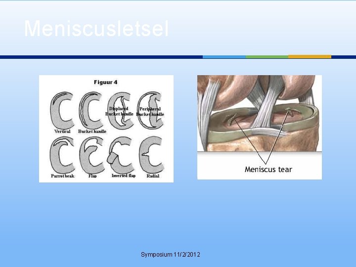 Meniscusletsel Symposium 11/2/2012 