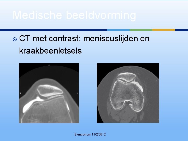 Medische beeldvorming CT met contrast: meniscuslijden en kraakbeenletsels Symposium 11/2/2012 