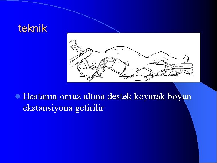 teknik l Hastanın omuz altına destek koyarak boyun ekstansiyona getirilir 