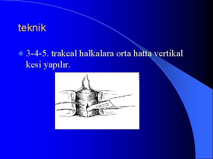 teknik l 3 -4 -5. trakeal halkalara orta hatta vertikal kesi yapılır. 