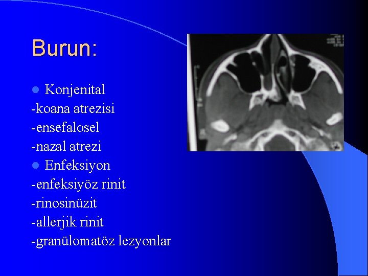 Burun: Konjenital -koana atrezisi -ensefalosel -nazal atrezi l Enfeksiyon -enfeksiyöz rinit -rinosinüzit -allerjik rinit