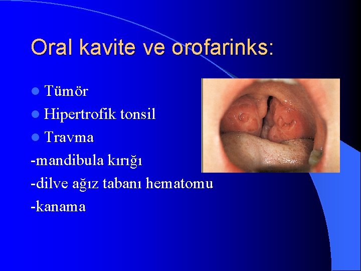 Oral kavite ve orofarinks: l Tümör l Hipertrofik tonsil l Travma -mandibula kırığı -dilve