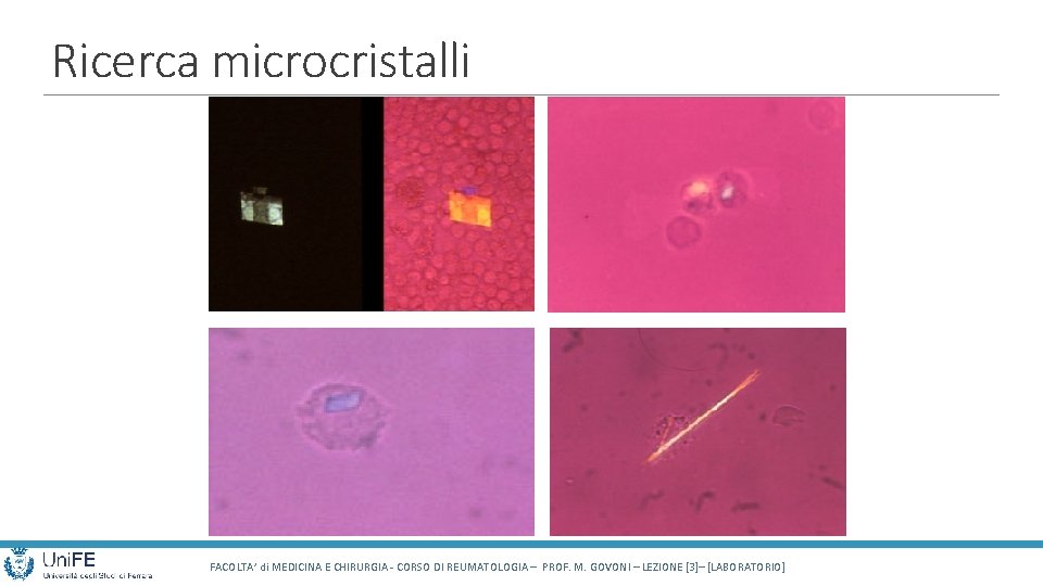 Ricerca microcristalli FACOLTA’ di MEDICINA E CHIRURGIA - CORSO DI REUMATOLOGIA – PROF. M.