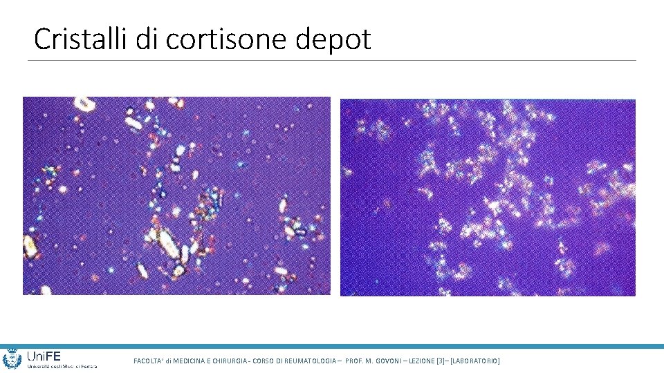 Cristalli di cortisone depot FACOLTA’ di MEDICINA E CHIRURGIA - CORSO DI REUMATOLOGIA –