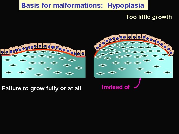 Basis for malformations: Hypoplasia Too little growth Failure to grow fully or at all