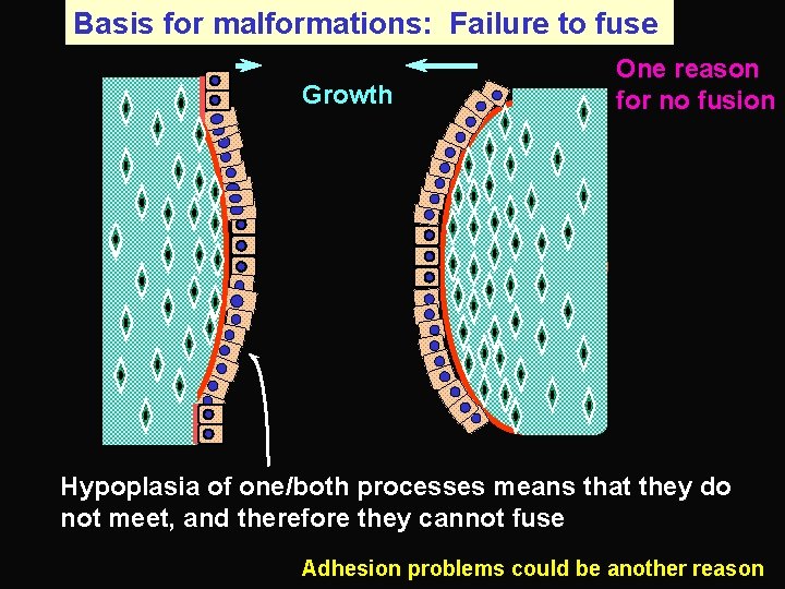 Basis for malformations: Failure to fuse Growth One reason for no fusion Hypoplasia of