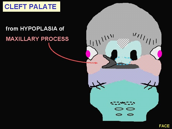 CLEFT PALATE from HYPOPLASIA of MAXILLARY PROCESS FACE 