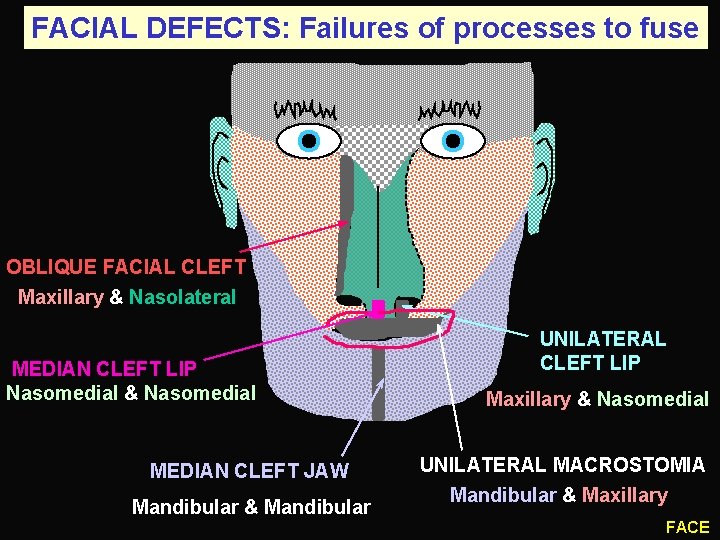FACIAL DEFECTS: Failures of processes to fuse OBLIQUE FACIAL CLEFT Maxillary & Nasolateral MEDIAN