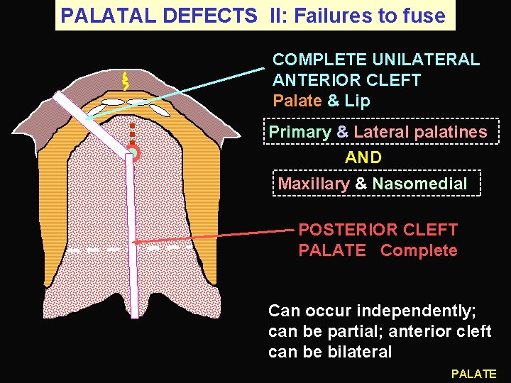 PALATAL DEFECTS II: Failures to fuse COMPLETE UNILATERAL ANTERIOR CLEFT Palate & Lip Primary