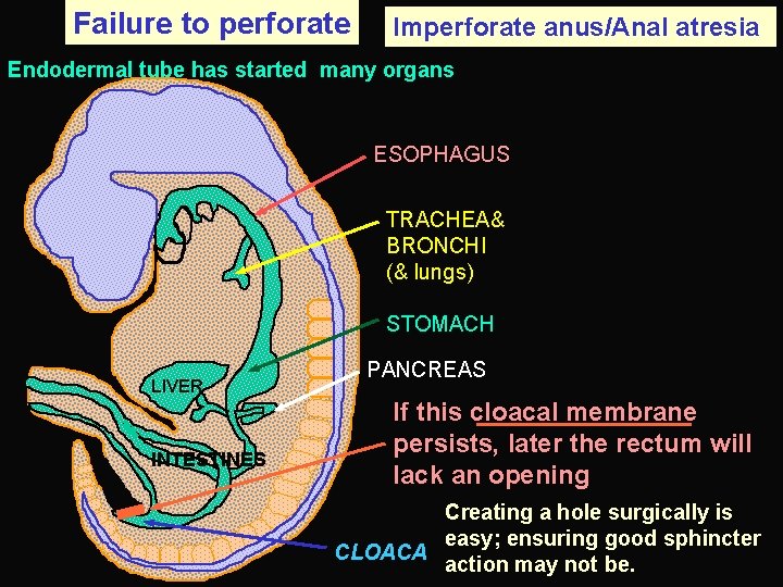 Failure to perforate Imperforate anus/Anal atresia Endodermal tube has started many organs ESOPHAGUS TRACHEA&