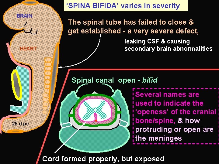 ‘SPINA BIFIDA’ varies in severity BRAIN HEART The spinal tube has failed to close