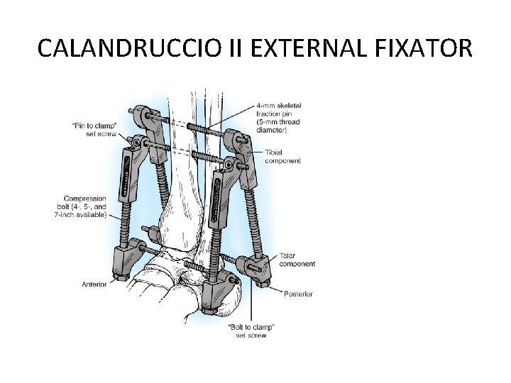 CALANDRUCCIO II EXTERNAL FIXATOR CALANDRUCCIO II EXTERNAL FIXATOR
