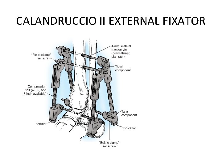 CALANDRUCCIO II EXTERNAL FIXATOR 