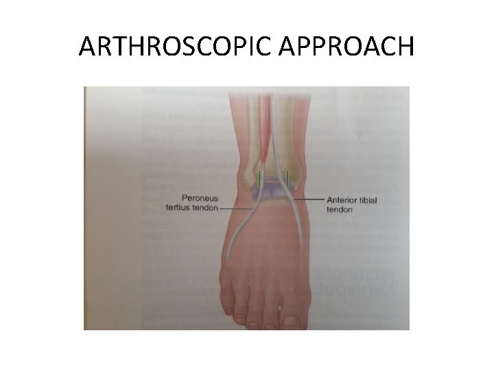 ARTHROSCOPIC APPROACH ARTHROSCOPIC APPROACH