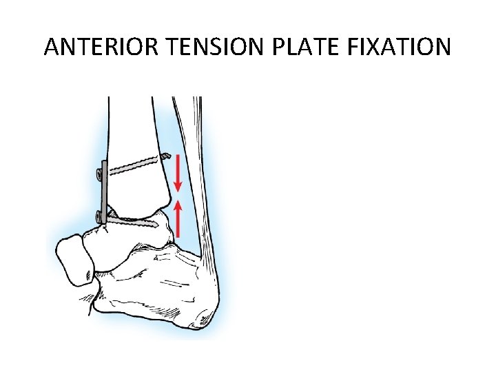 ANTERIOR TENSION PLATE FIXATION ANTERIOR TENSION PLATE FIXATION