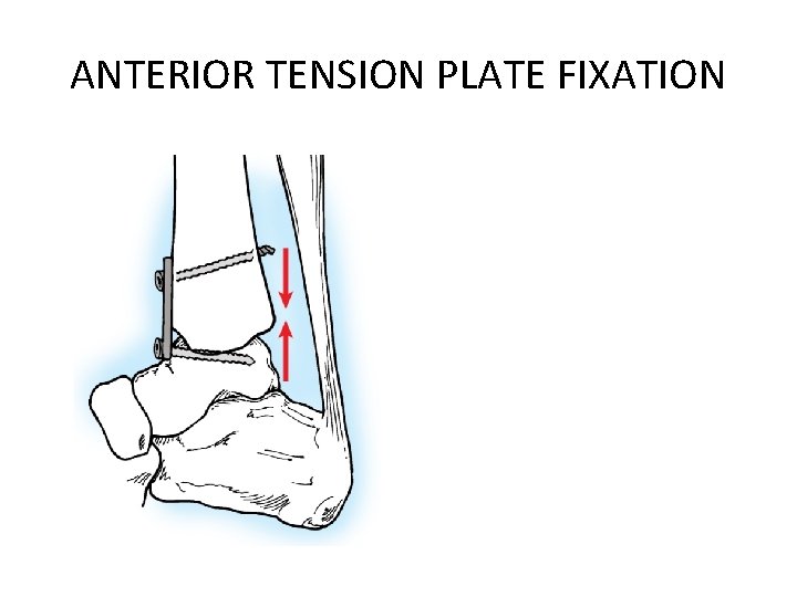 ANTERIOR TENSION PLATE FIXATION 