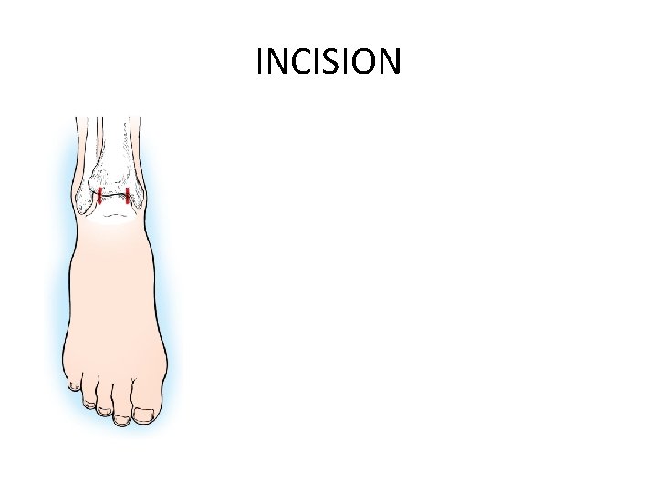 INCISION 