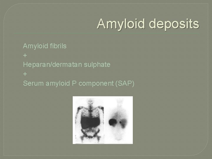 Amyloid deposits Amyloid fibrils + Heparan/dermatan sulphate + Serum amyloid P component (SAP) 