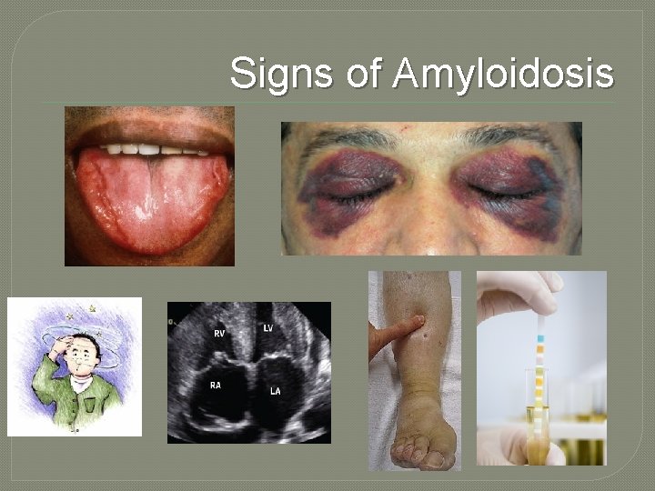 Signs of Amyloidosis 