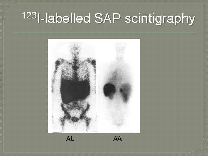 123 I-labelled AL SAP scintigraphy AA 