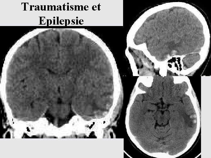 Traumatisme et Epilepsie 