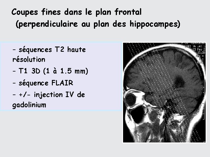 Coupes fines dans le plan frontal (perpendiculaire au plan des hippocampes) – séquences T