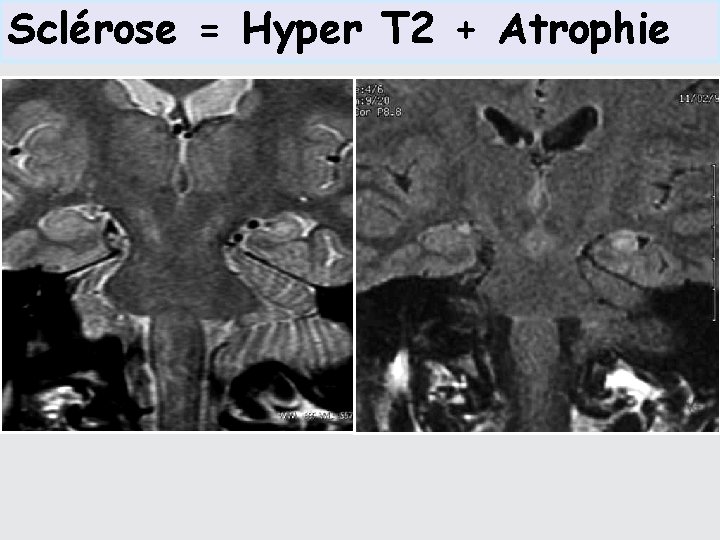Sclérose = Hyper T 2 + Atrophie 