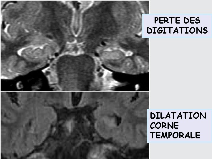 PERTE DES DIGITATIONS DILATATION CORNE TEMPORALE 