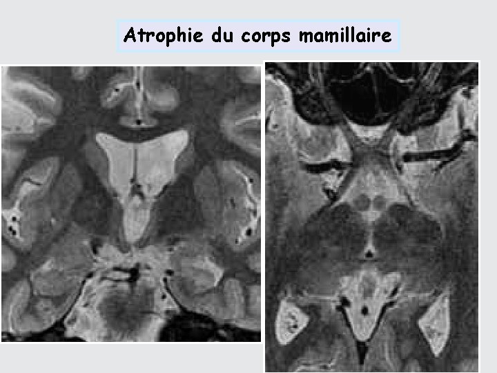 Atrophie du corps mamillaire 