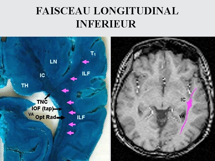 FAISCEAU LONGITUDINAL INFERIEUR T 1 LN IC ILF TH IC TNC IOF (tap) VA